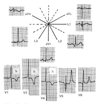 f) Cardiomiopatía hipertrófica sobre todo con compromiso asimétrico del septum interventricular (ondas Q anormales en DI, DII, DIII, avl,