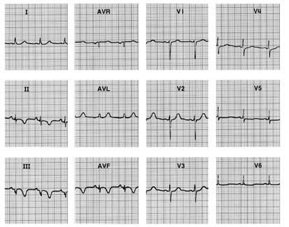 Los infartos con ondas Q son anatómicamente mayores dando fracción de eyección más baja, mayor mortalidad hospitalaria, mayor tendencia a la expansión del infarto y remodelación ventricular.