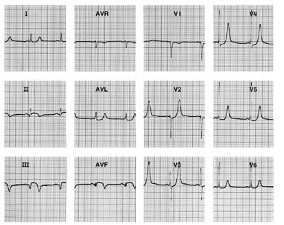 La mortalidad a un año entre infartos con onda Q y sin onda Q son comparables (ver también FIGURAS 9.74 y 9.85) (FIGURA 9.72 infarto no Q) (FIGURAS 9.103 y 9.104 infarto Q).
