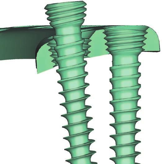 Placa de fijación vertebral torácico-lumbar TSLP. Placa de fijación vertebral torácico-lumbar.