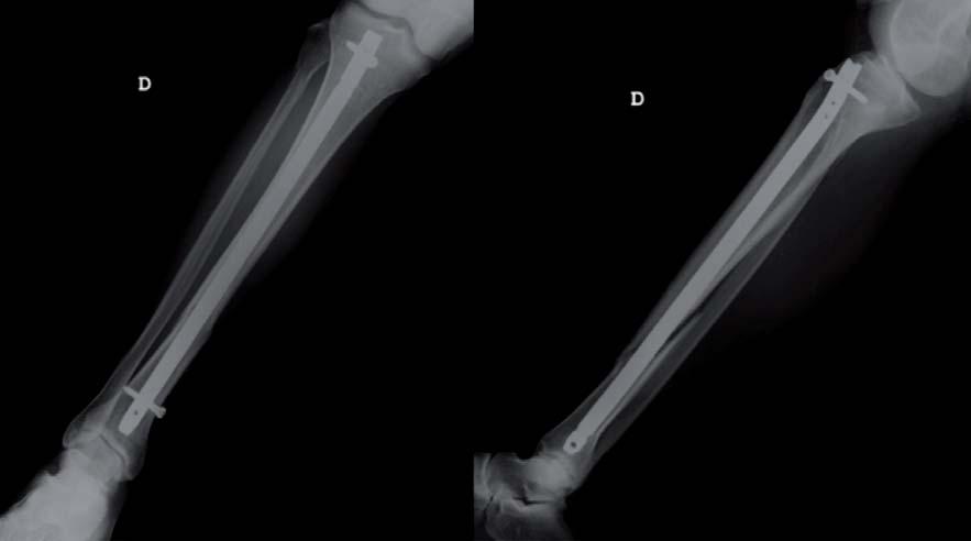 595 y el tobillo no puedan ser valorados con la proyección obtenida, deben solicitarse radiografías específicas de rodilla y tobillo. Tomografía axial computarizada (TAC).