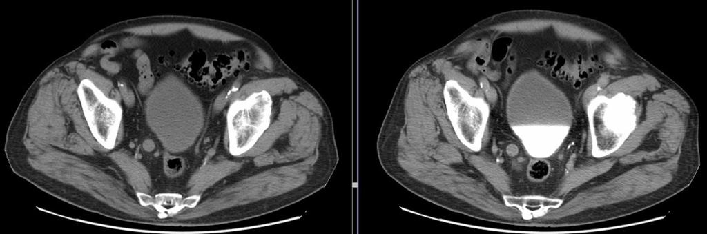 Fig. 14: Izquierda. TAC basal. Dilatación del uréter distal derecho observándose isodenso. Derecha. TAC en fase de eliminación.