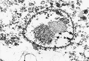 Agregado fibroso en el núcleo de una neurona de una paciente con Huntington Agregados fibrilares de