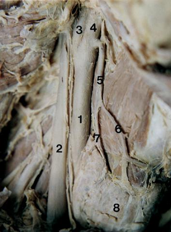 ARTERIA TIROIDEA SUPERIOR arteria tiroídea superior se origina de la arteria carótida externa en 67,3 %, de la arteria carótida común en 16,4 % a nivel de la bifurcación carotídea en 15,4 % y de un