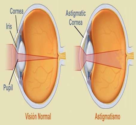ASTIGMATISMO Es un defecto de refracción que se produce debido a que existe diferente capacidad de refracción entre dos meridianos oculares y en consecuencia los objetos se ven
