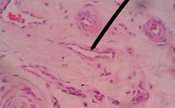 fibroso (*) Arteriolas (a); Vénulas