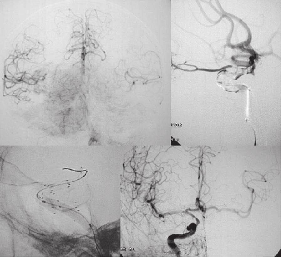 376 D. Escudero et al A B C D Figura 4 A) Arteriografía selectiva de la arteria vertebral a través de la que se rellena de forma muy tardía la circulación anterior.