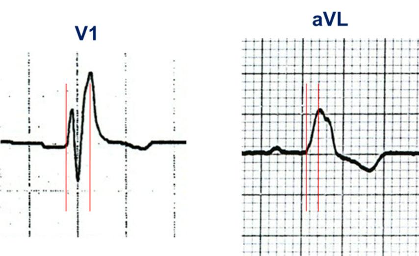 El latido debe tener un origen supraventricular: Esta condición señala que el complejo QRS debe estar precedido por una onda P (sinusal o ectópica) y que debe existir asociación auriculoventricular