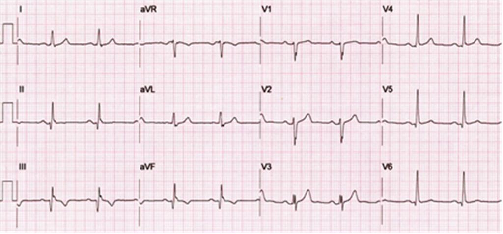 En la figura 45 se muestra un infarto antiguo de miocardio de la región inferior más un bloqueo del