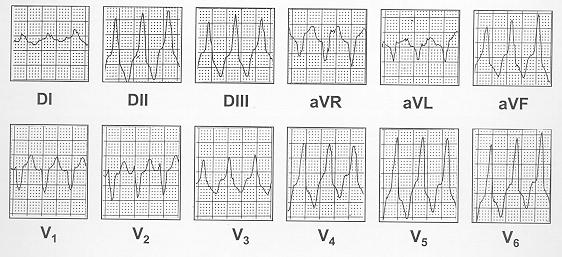 Los complejos QRS son anchos (> 120 mseg). La frecuencia de la taquicardia es de 200 LPM aproximadamente. Figura 58. Taquicardia ventricular con forma de bloqueo de rama derecha.