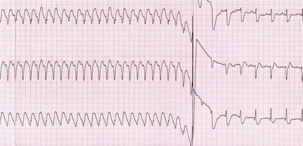 Figura 73 b La figura 73 a muestra el inicio de una taquicardia ventricular monomórfica sostenida en el contexto de un infarto de miocardio de la región inferior.