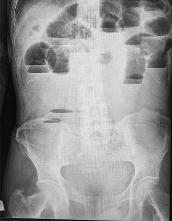 importancia que el médico radiólogo al realizar su informe responda al cirujano las siguientes preguntas: La obstrucción está en el intestino delgado? Qué tan severa es?