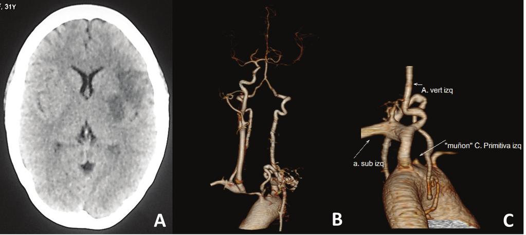 Arteritis de Takayasu : Etiología inhabitual de infarto cerebral. Reporte de un caso.