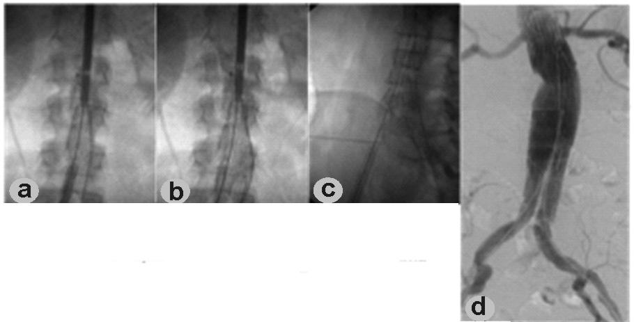 Tratamiento endovascular de los aneurismas de la aorta abdominal 59 Fig. 2.