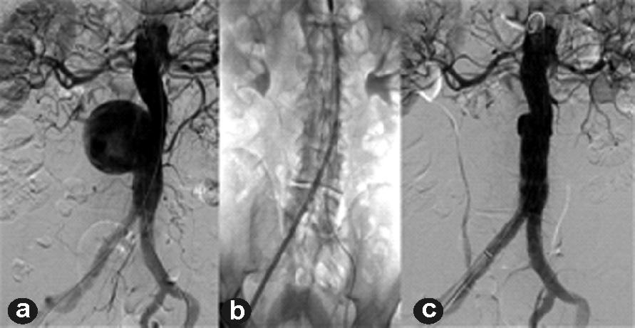 Tratamiento endovascular de los aneurismas de la aorta abdominal 61 La técnica de chimenea permite compensar la carencia de endoprótesis fenestradas mediante el implante de prótesis por acceso