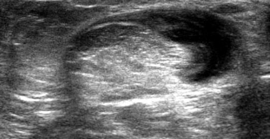 Rotura tendinosa parcial reciente 1 2 Imagen transversal(1) y longitudinal (2)del
