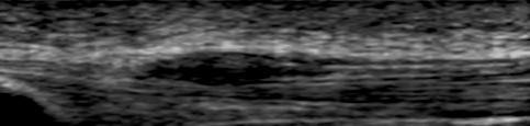 Rotura tendinosa reciente r tr Imagen longitudinal del tendón rotuliano mostrando