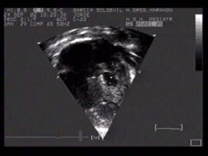 VD VI Arco Aortico Imágenes Ecocardiograficas de Hipoplasia de Ventrículo Izquierdo en las que se observa un Ventrículo Izquierdo (VI) Hipodesarrollado; Ventrículo Derecho (VD) Dilatado, y Arco