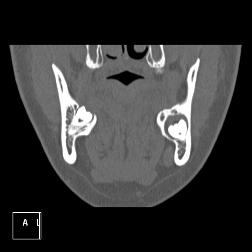 Fig. 3: Quiste odontogénico cordal inferior izdo