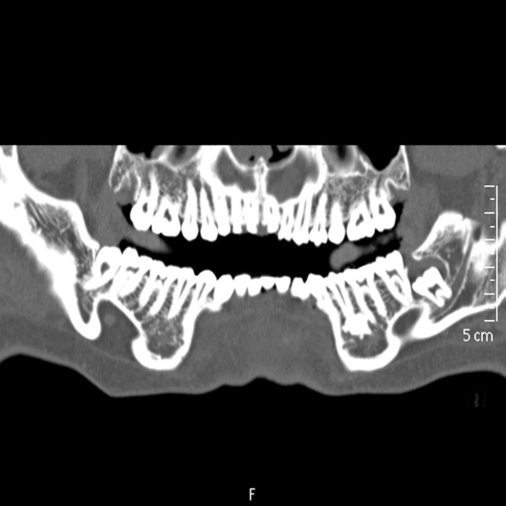 Fig. 5: Quiste odontogénico cordal 38 en contacto con canal del nervio dentario inferior izdo que puede ocasionar problemas en extracción.