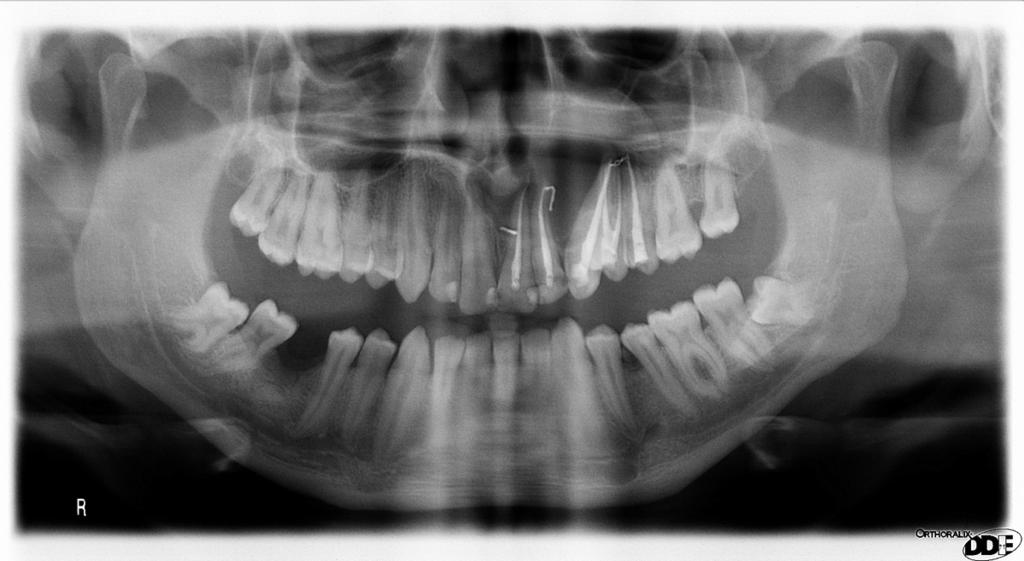 Fig. 15: Ameloblastoma del maxilar.