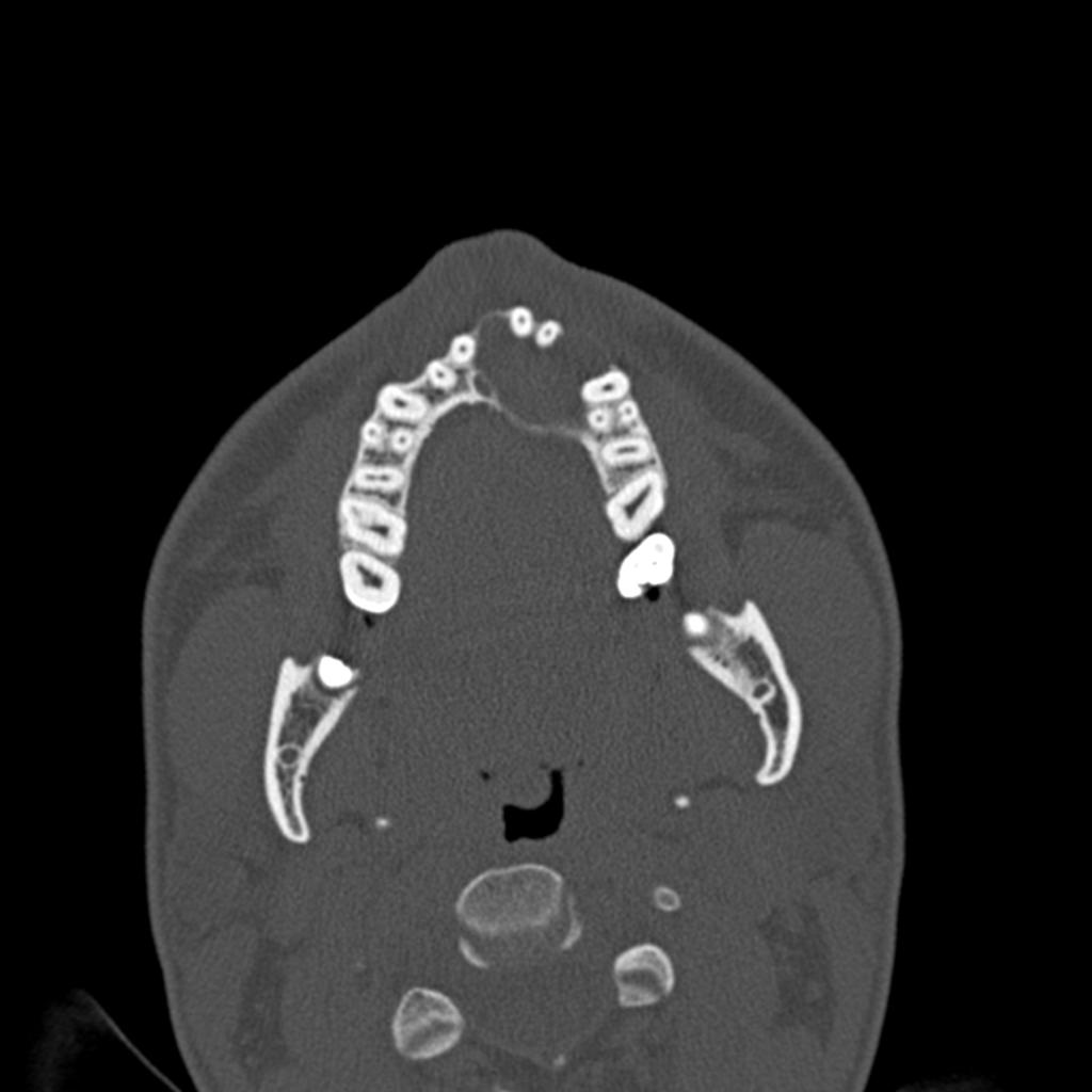 Fig. 16: Ameloblastoma maxilar izdo que desplaza piezas dentarias, cruza la línea