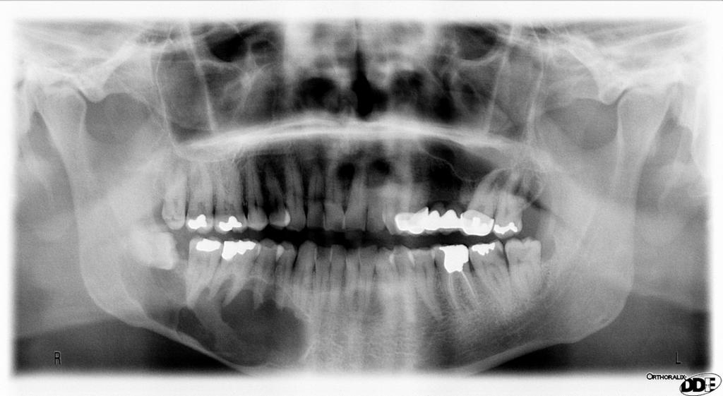 Fig. 19: Ameloblastoma cuerpo mandibular