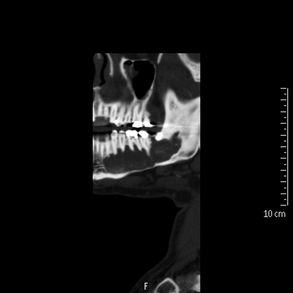 Fig. 21: Ameloblastoma gigante en cuerpo mandibular derecho, lleno de contenido con áreas