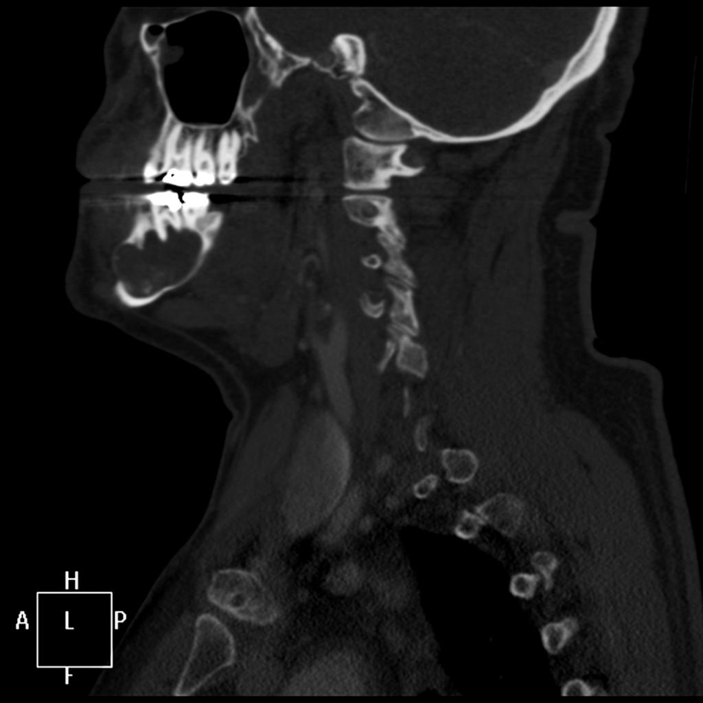 Fig. 22: Ameloblastoma gigante en cuerpo mandibular derecho, lleno de contenido con áreas de