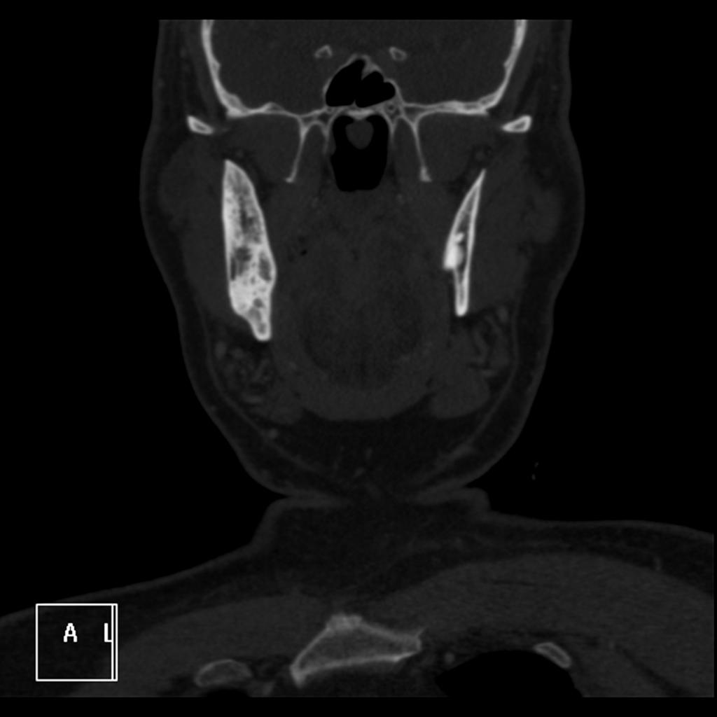 Fig. 24: Displasia Fibrosa Monostótica de la rama mandibular derecha, que muestra aumento de tamaño con