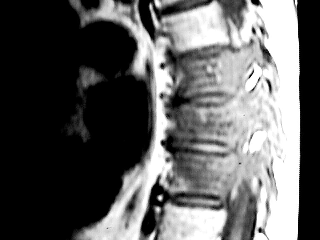 Secuencia T2 sagital de columna dorsal donde se observan lesiones metastásicas hipointensas que involucran tanto el cuerpo como los pedículos de D7, D8 y D9, no hay compromiso medular.