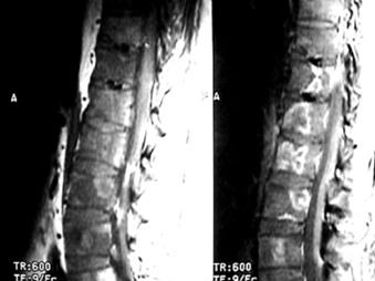 Figura 6. Secuencia T2 con Gadolinio en plano sagital en la cual se observa fractura por aplastamiento y reforzamiento del cuerpo vertebral de D8 en paciente con cáncer colónico.