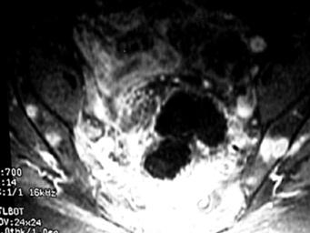 IRM realizada posterior a quimio y radioterapia evidenciando aún actividad tumoral. compresión del cordón medular, entre los niveles de bloqueo mielográfico.