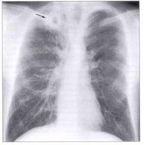 Legionellosis must be kept in mind in case of pneumonia with lung