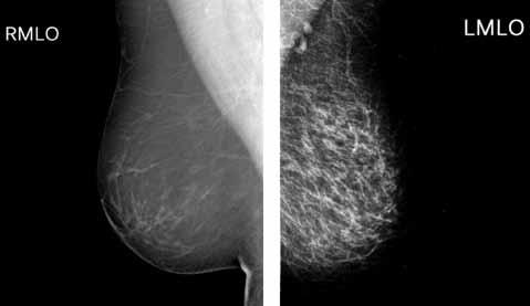 La necesidad e importancia del control de calidad en mamografía Galván-Espinoza HA, et al Figura 1. Mamografía. A) Imagen de alta calidad.