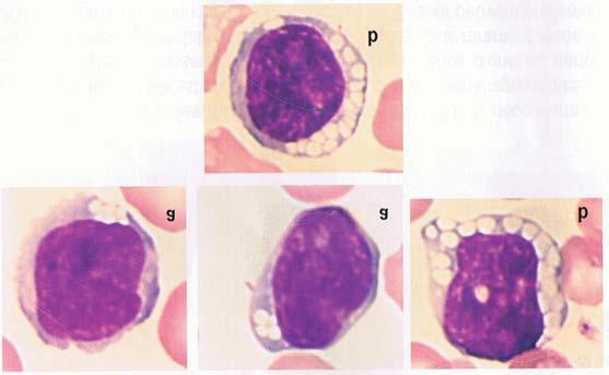 (a). La presencia de una supralínea vacuolas en color rosa en los linfocitos (linfocitos rhodocircés) (b) frecuentemente se observa en alguna MPS (Enfermedad de