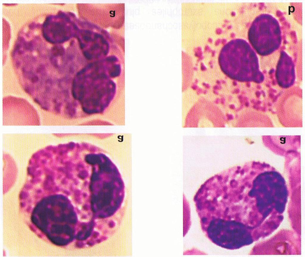 Figura 7: La presencia de polinucleares eosinófilos anormales se observa en pacientes