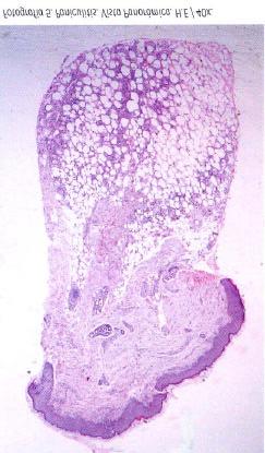 Biopsia de piel: Paniculitis compuesta por histiocitos y células gigantes con cristales de colesterol intracelulares (fotografías 5, 6, 7 y 8).