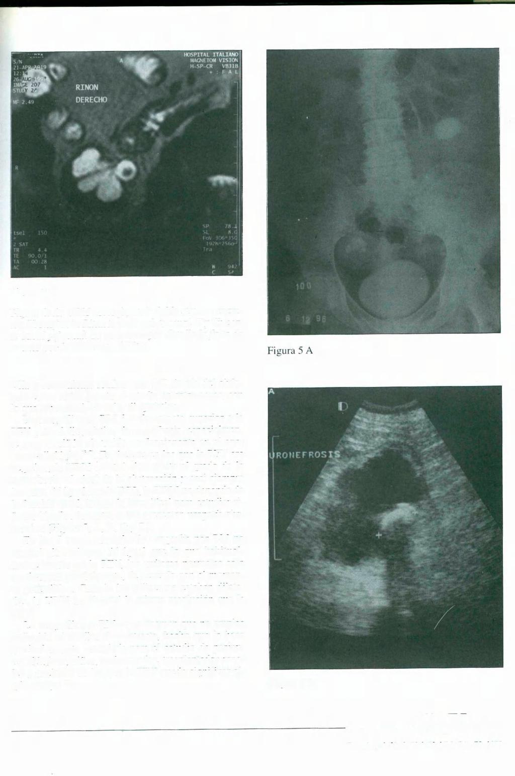 Figura 4 C Figura 4: A: URM corte frontal: doble sistema excretor. Uronefrosis. Litiasis en la pelvis renal.