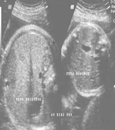 Síndrome de transfusión feto-fetal en un embarazo de trillizos bi-corial-tri-amniótico igual sexo manejado con fotocoagulación láser guiada por fetoscopio.