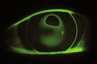 Un inadecuado levantamiento del borde (Fig. 5) sera visto como una banda de fluoresceína de menos de 0.5 mm y un anillo oscuro de toque cerca del borde del lente.