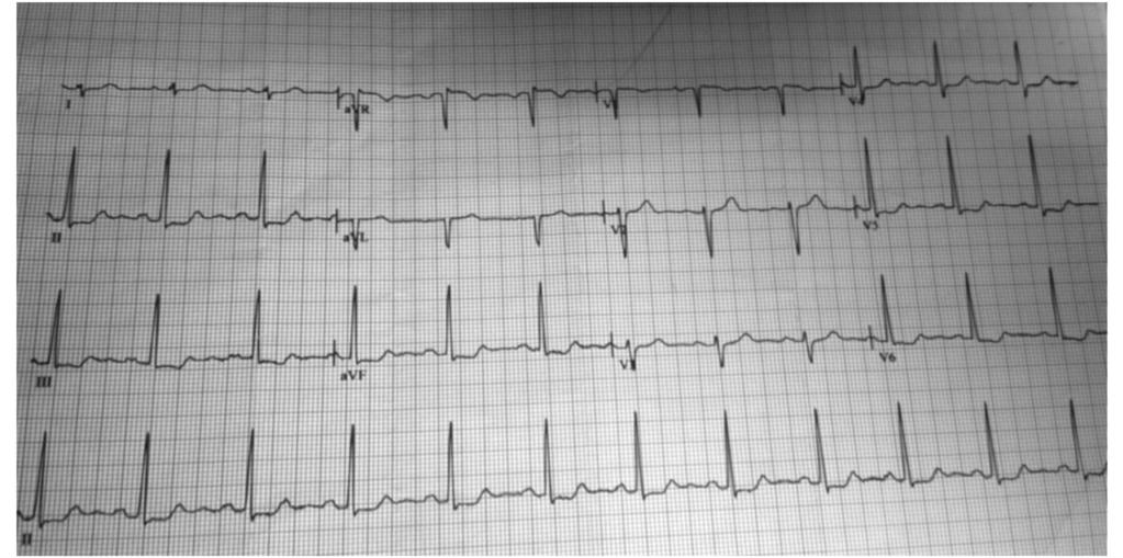 Figura 1. EKG: el electrocardiograma del paciente solo nos muestra cambios inespecíficos del segmento ST. u otros datos que sugieran insuficiencia cardiaca derecha.