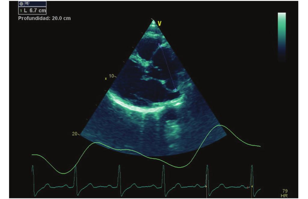 Figura 3. Ecocardiograma transtorácico en eje paraesternal largo. Obtenido de un paciente de 52 años del Hospital San Juan de Dios con aneurisma del seno de Valsalva.