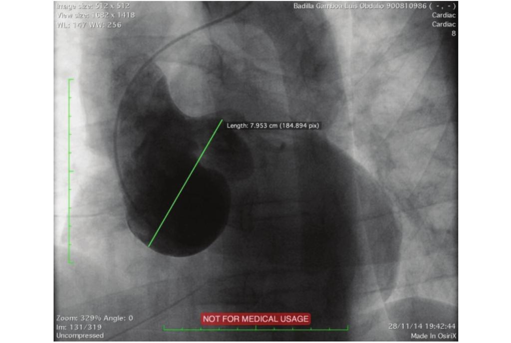 Figura 6. Aortograma, nótese el díametro mayor de la aorta ascendente a nivel de los senos de Valsalva. supervivencia media de 3,9 años en los pacientes con aneurisma del seno de Valsalva roto.
