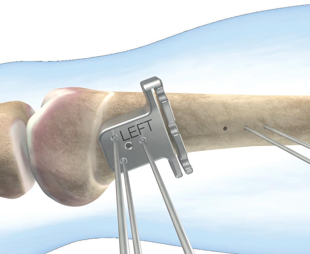 Realización de la osteotomía distal Elija la guía de corte distal adecuada (consulte la Tabla 2) y deslícela sobre las agujas guía distales.