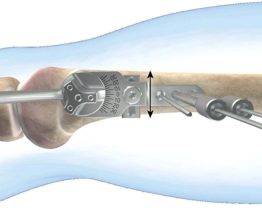 FIGURA 3: ubicación y alineación de la parte proximal de la guía de pines iniciales Osteotomía de extensión Osteotomía en cuña Con el eje proximal de la guía de pines iniciales en paralelo a la