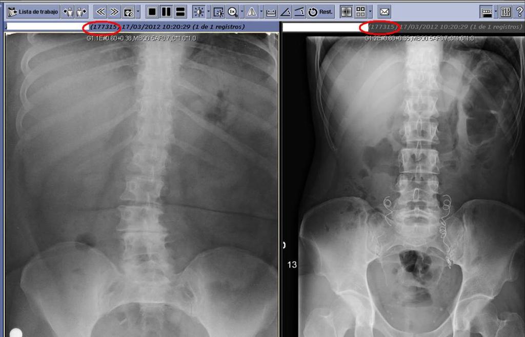 Fig. 6: Caso 3b. Al abrir el estudio se observa claramente dos rx de abdomen de distintos pacientes.