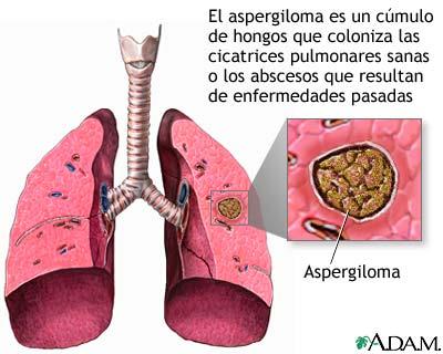 MICOSIS PULMONARES ASPERGILOSIS: Aspergillus fumigatus Asociación a inmunodepresión (sida, trasplantes) MANIFESTACIONES CLINICAS: 1.