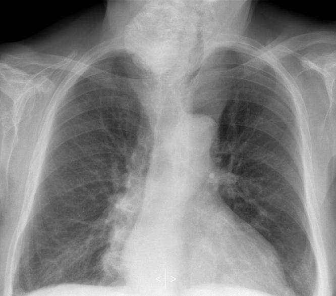 b.- Descripción. Paciente 1 Bocio. Radiografía de la izquierda: calcificación paratraqueal derecha, con desplazamiento de la traquea a la izquierda.