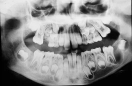 Med Oral Patol Oral Cir Bucal 2004;9:454-8. que provocaba una asimetría facial. La palpación fue indolora.